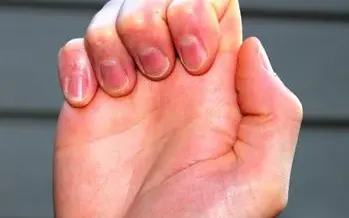 Hand Tendon Glide Exercise (Part 2) — exercise video thumbnail